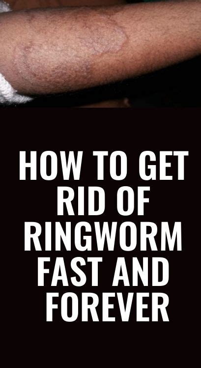 Maybe you would like to learn more about one of these? Here we will know about how to get rid of ringworm fast ...