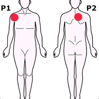 The shoulders are an important part of our body. (PDF) Acute Effects of Dry Needling on Posterior Shoulder Tightness: A Case Report