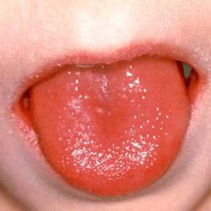 La scarlatine est une maladie infectieuse bactérienne. Scarlatine : maladie infectieuse bactérienne - Bébé à Bord