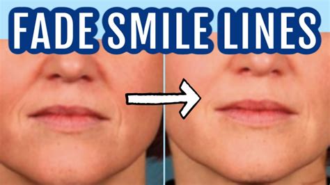 Now that we've learnt how to prevent smile lines from forming in the first place. 12 ways to fade smile lines (nasolabial folds)| Dr Dray ...