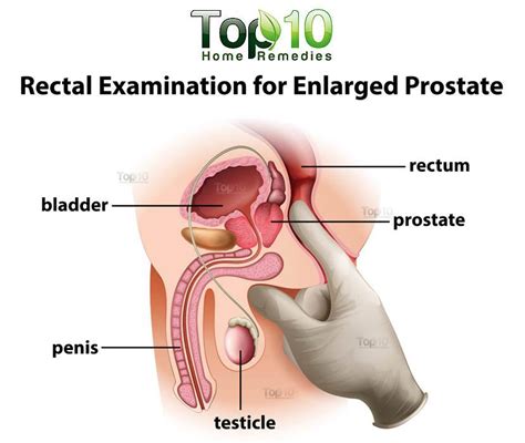 How to tell if your cancer has metastasized. Home Remedies for Enlarged Prostate | Top 10 Home Remedies