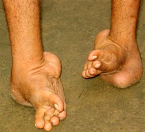 If someone has a club foot , they are born with a badly twisted foot. Neglected Club Foot : WTF