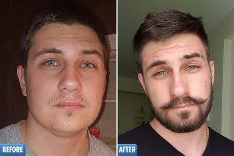 We did not find results for: Minoxidil Beards Before And After | Beard Style Corner