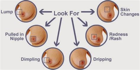 Clinically, inflammatory breast cancer mimics mastitis. Penyakit Tumor dan Ca Mammae: Askep Tumor dan Ca Mammae