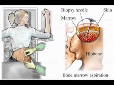 Bone marrow is a thick liquid inside your bones. Bone marrow cancer pictures - YouTube