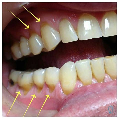 Tooth abfraction and oral health. V-shaped wear in the cervical part of the tooth is known ...