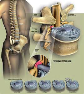 Degenerative disc disease causes the disc to lose water content and begin to flatten as shown in the picture. Non-Surgical Spinal Decompression Therapy | Irvine Spine ...