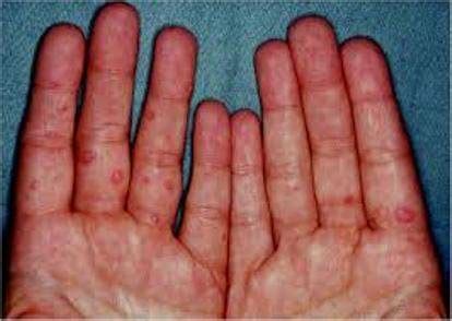 This is followed a day or two later by flat discolored spots or bumps that may blister, on the hands. Increase in cases of coxsackie viral infection reported in ...