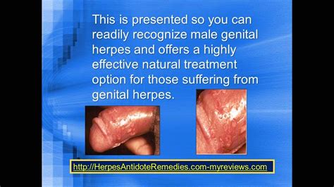 Herpes is one of the most common sexually transmitted diseases which can affect multiple organ systems including the lips and genitals. Complications of Genital Herpes Infection - YouTube