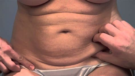 Infections due to negligence in wound care can lead to a bigger or thicker scar. Can C-section scars be fixed with a Mini Tummy Tuck? - YouTube