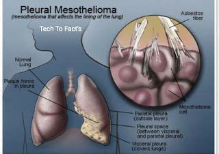 How your mesothelioma stage affects your life expectancy? What is Pleural Mesothelioma?Pleural Mesothelioma survival ...