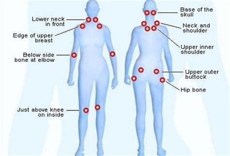 Fibromyalgia tender points are the spots of pain located around different areas on the body that hurt when pressed firmly. Fibromyalgia Symptoms, Diagnosis & Treatment