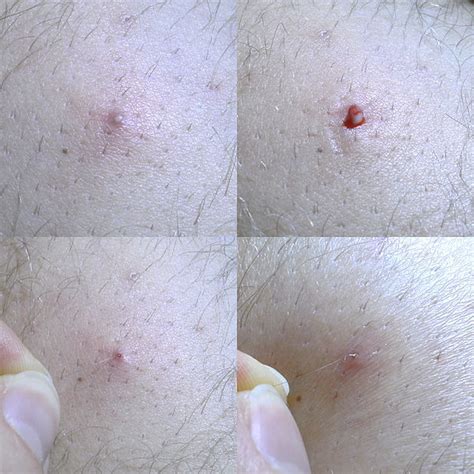 Knot or lump in pubic hair im 14 and i have ingrown pubic hair what should i do ingrown pubic hairs (men) pubic ingrown hair on the side of my vulva i'm unsure if it is an ingrown hair or something. Ingrown Hair: Symptom, Treatment and Prevention | MD ...