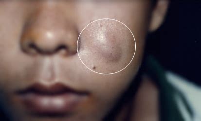 Untuk menghilangkan jerawat secara alami, disarankan untuk membersihkan wajah menggunakan sabun setelah mencuci muka, anda bisa mengoleskan toner ke kulit wajah. Cara Mengobati Benjolan Di Wajah Seperti Jerawat Tapi ...