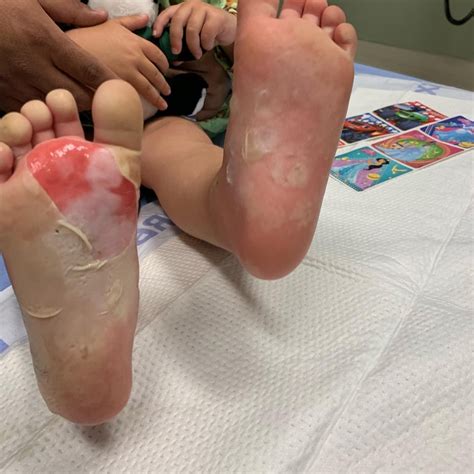 Grills could still be operated during the ban, but it had to be a true grill and not a makeshift cooking device. Los Osos toddler hospitalized after burning her feet in a ...