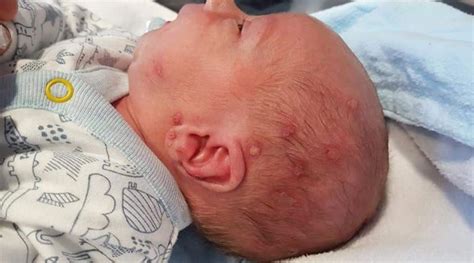 Mottling usually doesn't occur past 6. Newborn baby almost dies from herpes after kiss from ...