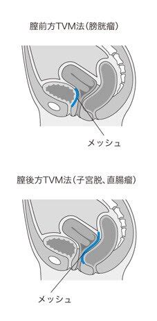 骨盤臓器脱とは？外に出れない人も…症状や治療法を詳しく ...
