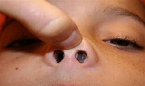 But in blackheads, the clog is open to the air. Bump on Nose, Inside Nose, Small Red, White Painful Bump ...