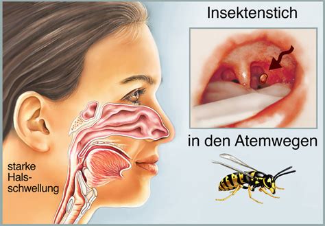 Weil es sehr fein ist, sollte kieselgur nicht eingeatmet werden, daher sollte man beim einsatz einen mundschutz tragen. Wespenstich, Was tun?