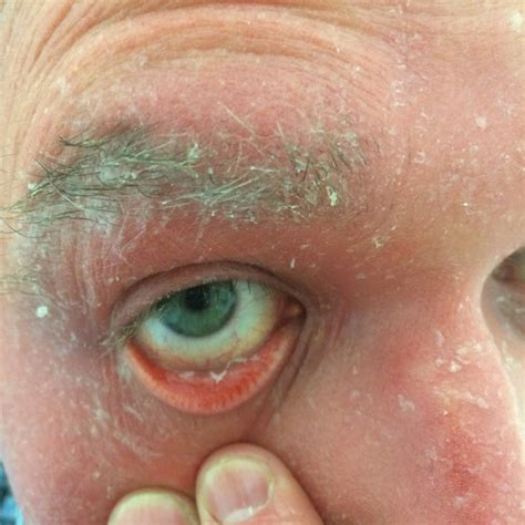 Pityriasis rubra pilaris is a skin condition with many different clinical presentations. My pityriasis rubra pilaris blog: Eye worms