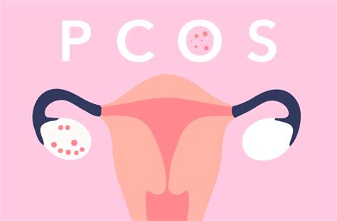 Pcos is a leading cause of female infertility. #BodyTalk: PCOS by LUÜNA naturals - LifeHub