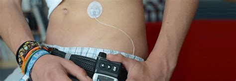 How your body makes glucose. Glukose-Monitoring: Wohin mit dem Sensor? - Medical Tribune