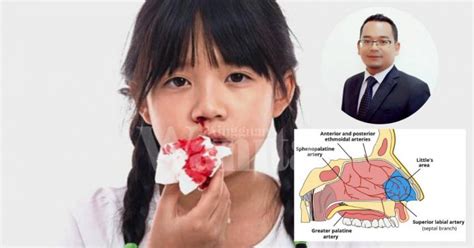 Lawati www.doctoroncall.com bagi cara untuk menghentikan hidung berdarah. Panik Hidung Anak Selalu Berdarah, Pakar ENT Ajar Lakukan ...