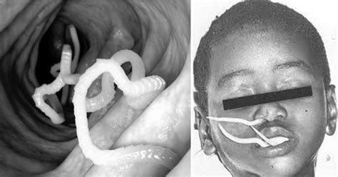 Check spelling or type a new query. Euww! Cacing Keluar Dari Mulut Dan Hidung , Tak Pernah ...