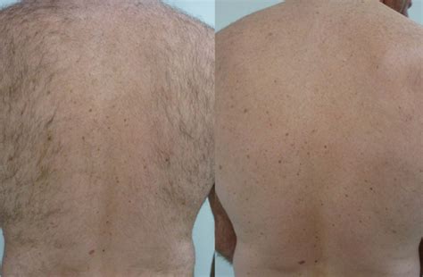 Clients come from near and as far as interstate and even overseas to visit our clinic, located in capalaba in the business district of beautiful redland city, queensland, we are just a short trip from those in brisbane, gold coast, logan and surrounds. Mens Laser Hair Removal Treatments in Brisbane & Maroochydore