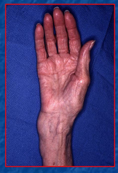 Distal radius fracture