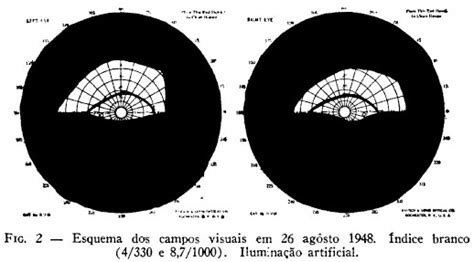 Arachnoiditis is a rare and progressive inflammatory disorder of the arachnoid mater. Hemianopsia altitudinal inferior por aracnoidite ...