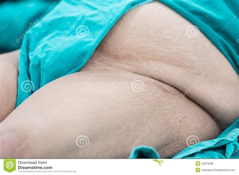 Groin pain can occur due to conditions of the. Prepare Groin Area For Operation Stock Photo - Image of ...