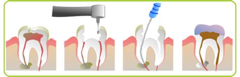 Lubang pada gigi yang dibiarkan saja atau tidak pernah diperiksakan ke dokter gigi, semakin lama akan semakin membesar. Klinik Pergigian Syarifah : Root Canal Treatment (RCT)