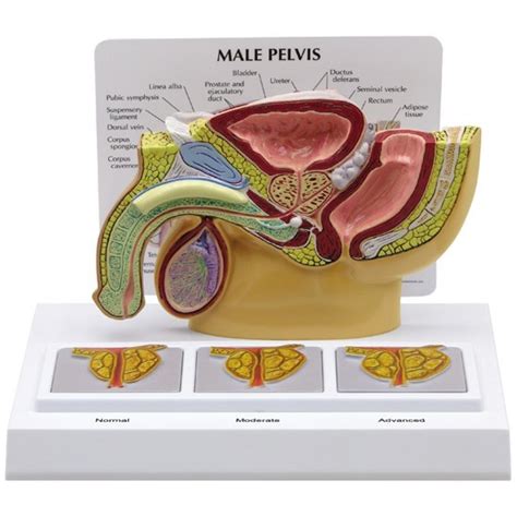 Human anatomy internal organs on man body urologist showing and pointing on male pelvis, anatomy of the male urinary and reproductive systems, cutaway cross section. Male Pelvis Section Model with Enlarged Prostates 3551 ...