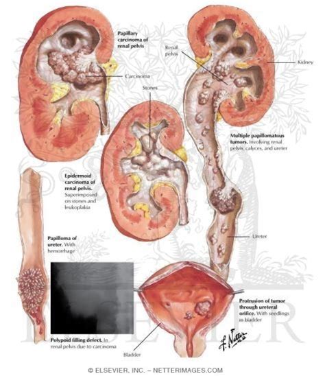 Renal pelvis and ureter cancers affect men more often than women. Ureteral Neoplasms; Cancer of Ureter; Ureteral Cancer