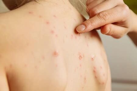 Jenis penyakit kulit yang sering diderita. Inilah Jenis Penyakit Kulit yang Dapat Menular Melalui ...