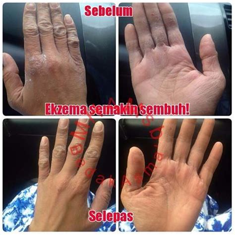 Batuk berkepanjangan bisa saja terjadi kepada orang dewasa. Stem Cell Malaysia: RAHSIA UNTUK CANTIK & AWET MUDA - Blog