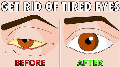 Dry eyes, also known as dry eye syndrome, occurs when your tears are not providing enough lubrication to your eyes. How to naturally get rid of tired eyes in 2 easy steps ...