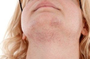 This lack of available information leaves many women without some very valuable information on how they can diminish the symptoms and. What Causes Facial Hair On Females - 2020 Hair Ideas ...