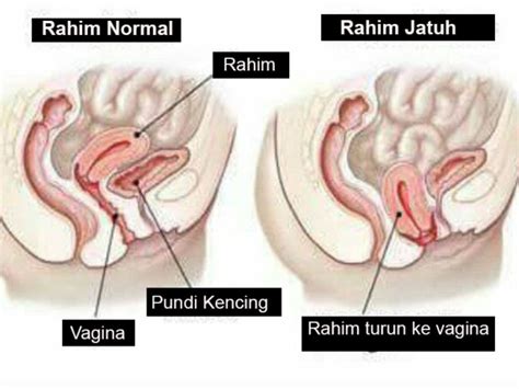 Ciri haid yang mirip dengan tanda kehamilan 1 minggu setelah berhubungan intim bagaimana cara memastikan kebenaran tanda kehamilan 1 minggu setelah berhubungan? 9 Tanda Rahim Tak Sihat, Jangan Biar Sampai Peranakan ...