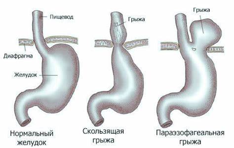 Диета и лечение грыжи пищевода Параезофагеальние грижа стравохідного отвору діафрагми: що це Параезофагеальние грижа стравохідного отвору діафрагми: що це Диета и лечение грыжи пищевода