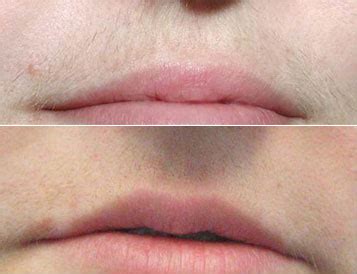 After laser hair removal treatments, your skin may appear slightly discolored. Laser Hair Removal - Vancouver Laser Skin Care Clinic
