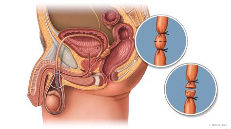 What vitamins should i take while on birth control. How To Increase Ejaculate Volume After Vasectomy