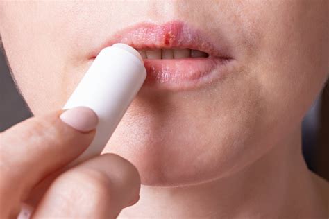 Typische symptome sind entzündete und schmerzhafte bläschen im bereich der lippen. Lippenherpes schnell und einfach bekämpfen - Besser Gesund ...