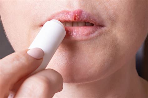 Dabei ist es egal, ob die bläschen gerade entstanden, aufgeplatzt oder bereits am abheilen sind. Lippenherpes schnell und einfach bekämpfen - Besser Gesund ...