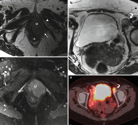 Vulvar cancer occurs when abnormal cells grow out of control in the vulva. Vulvar Cancer | Radiology Key