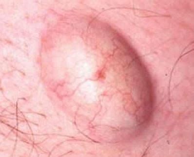 Posted on july 12, 2019 february 26. An Ingrown Hair Cyst Can Be Deep And Painful In Areas With ...