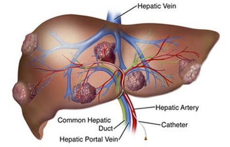 These tumors are not true liver cancers; Some significant Symptoms of Liver Cancer - TWB