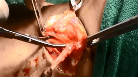 They come from the very important modification in the branchial apparatus arising during the embryogenesis of the neck. Branchial Fistula - YouTube
