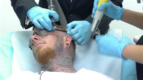 Tattoo removal by size category (e.g., knuckle, hand, sleeve) a flat rate per removal session. Crazy Video of Man Getting Face Tattoo Removed | Tattoo ...